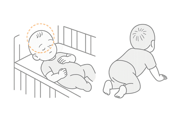 赤ちゃんの枕はげ 圧迫性脱毛症の典型例イラスト