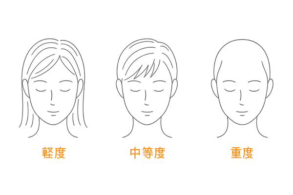 圧迫性脱毛症の軽度・中等度・重度進行図
