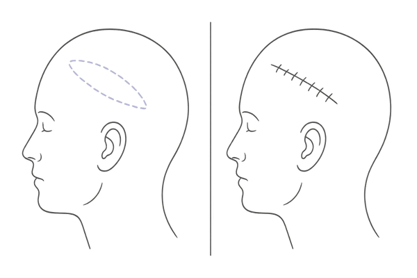 頭皮の瘢痕切除と縫縮術のビフォーアフターを示す線画