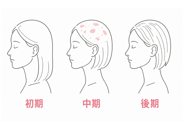 脂漏性脱毛症の初期・中期・後期を示す頭皮シルエット比較イラスト