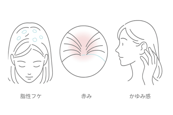 脂漏性皮膚炎の主要症状｜女性の頭皮のフケ・赤み・かゆみのイメージ