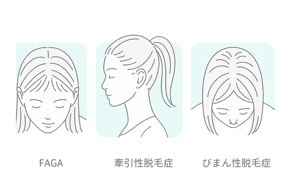 女性の前髪がスカスカになる主な原因（FAGA・牽引性脱毛症・びまん性脱毛症）の比較図