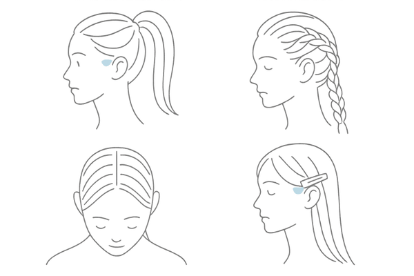 牽引性脱毛症の典型例｜こめかみ薄毛を進行させるNGヘアアレンジ4種