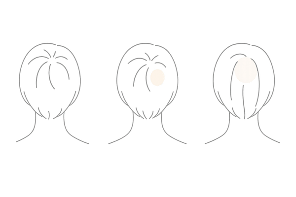女性のつむじハゲの見分け方|正常なつむじとの比較イラスト