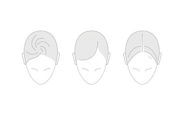 女性の薄毛タイプ比較|つむじハゲ・びまん性・牽引性の違いイラスト