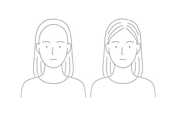 生まれつきの広いおでこ vs 薄毛進行の見分け方｜女性のM字はげ初期サインの比較図