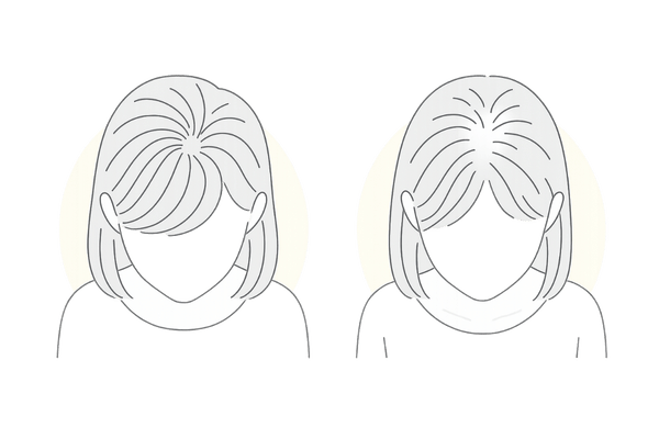 女性のつむじ薄毛の見分け方｜正常と薄毛の比較図（俯瞰）