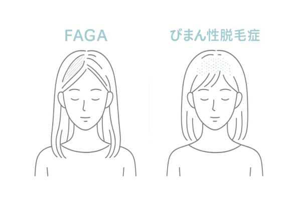 FAGAとびまん性脱毛症の違い|女性の薄毛パターン比較(頭頂部~分け目の透け vs 全体ボリューム低下)