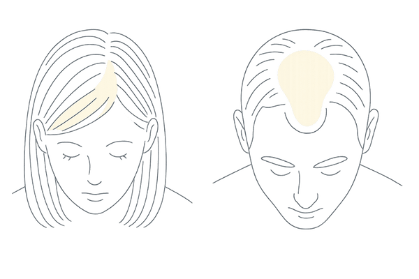 女性のびまん性薄毛と男性AGAの違い比較イラスト(分け目が目立つ女性パターンとM字・頭頂部の男性パターン)
