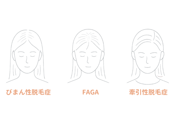 女性の薄毛タイプ比較図｜びまん性脱毛症・FAGA・牽引性脱毛症の違い