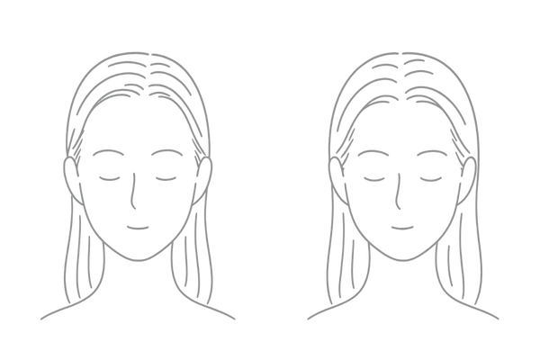 生え際の初期サインセルフチェック｜産毛密度とM字の変化（女性・おでこが広く見える前段階）