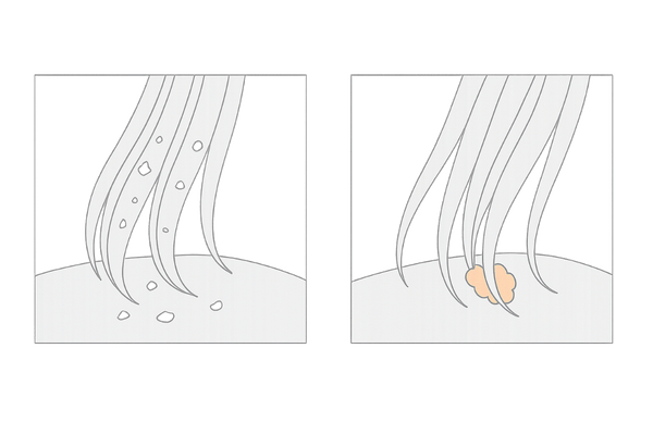 乾性フケと脂性フケの違い|頭皮乾燥セルフチェック用イラスト