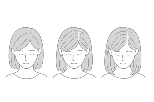 女性のびまん性脱毛症の進行パターン（分け目の広がり：通常→初期→中期）