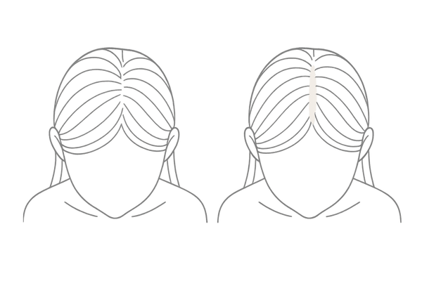 30代女性のびまん性脱毛症の見え方|分け目のボリューム低下を比較する図