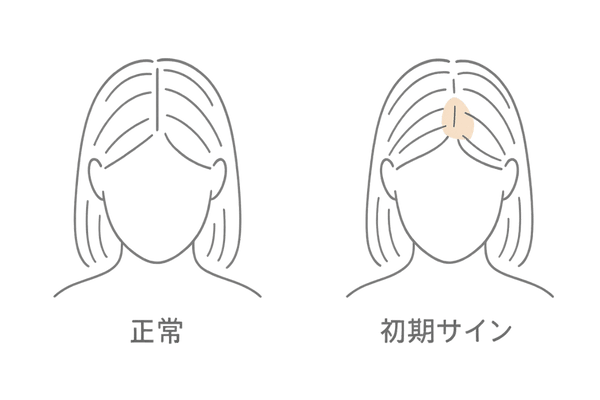 女性の遺伝性薄毛の初期サイン|分け目の拡大・つむじの透け感の比較イラスト