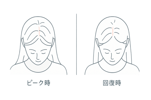 産後の回復イメージ|分け目の広がりが改善し産毛が増える比較イラスト