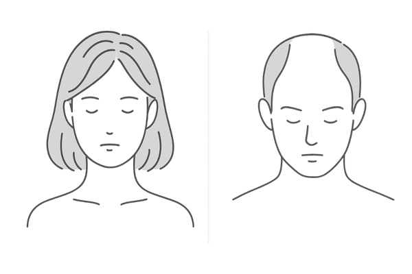女性の薄毛の特徴(びまん性)と男性型の違いを示す比較図|女性の薄毛予防