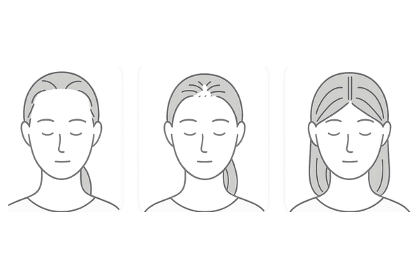 女性の生え際後退セルフチェック|おでこの広がり・産毛化・頭皮の透けサイン