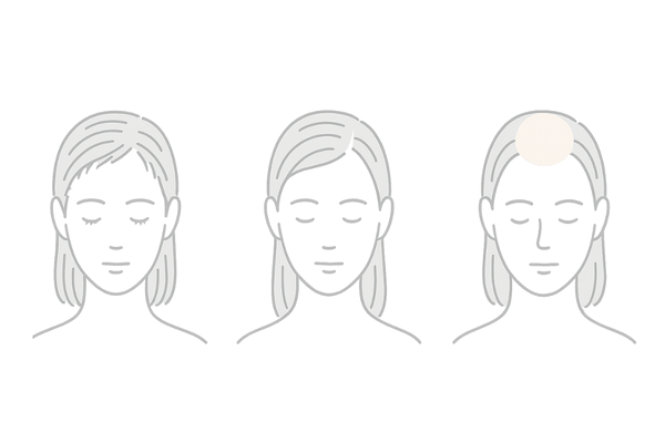 女性の生え際後退の進行度イメージ|初期・中期・後期の見た目変化