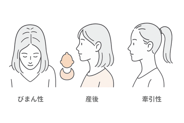 女性特有の脱毛パターン|びまん性脱毛症・産後の抜け毛・牽引性脱毛症のイラスト