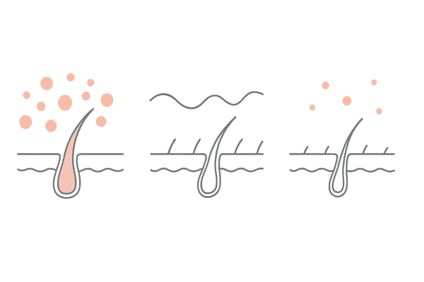 ホルモンバランスとFAGAの影響｜年代で変わる生え際と毛包イメージ