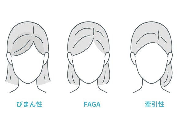 女性の薄毛タイプと植毛適応の図解(びまん性・FAGA・牽引性の比較)