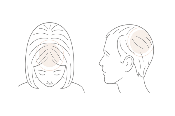 女性のびまん性薄毛と男性AGAの進行パターン比較イラスト｜抜け毛の男女差
