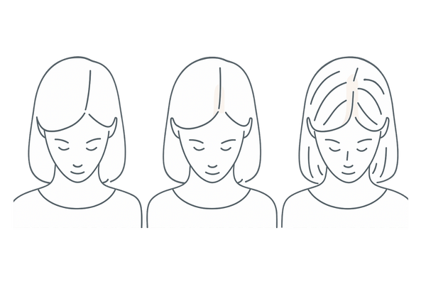 FAGAの進行パターン（ルードヴィッヒ分類 I〜III）女性頭頂の比較イラスト