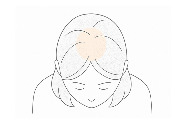 びまん性脱毛症とは(頭部全体に均等に薄くなる)