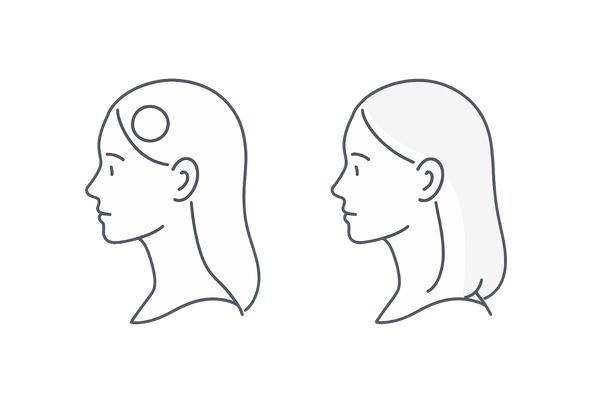 局所型(円形脱毛症)との違い(びまん性は広範囲・均一)