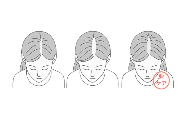 ルートヴィヒ分類のイメージ(女性の進行度)