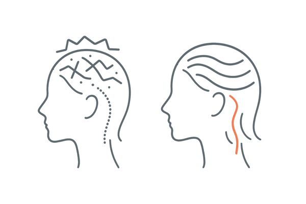 ストレスによる頭皮の血行不良イメージとリラックスの重要性