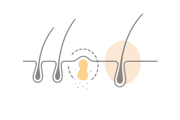 皮脂バランスの乱れによる頭皮トラブルと抗炎症ケアのイメージ図