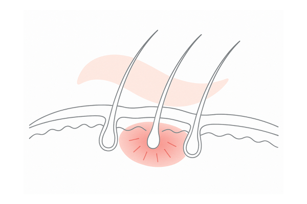 グリチルリチン酸ジカリウムなどの抗炎症成分で頭皮の赤みを抑えるイメージ