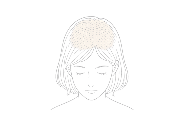 広範囲にボリュームが減るびまん性脱毛症のイメージ