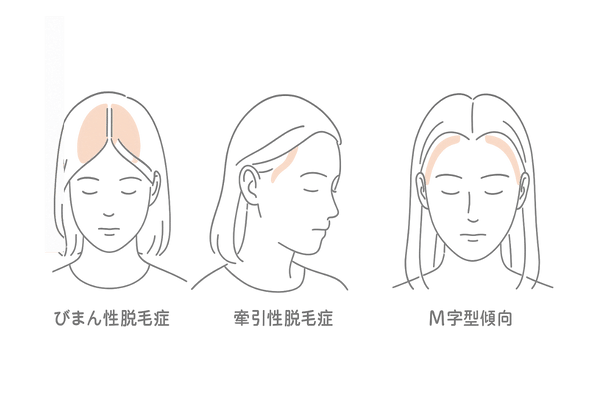 女性の生え際薄毛タイプ別（びまん性・牽引性・M字型）の比較イラスト