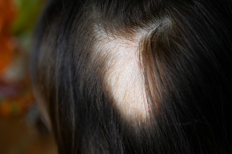 【医師監修】女性の円形脱毛症の原因｜更年期や女性ホルモンの影響