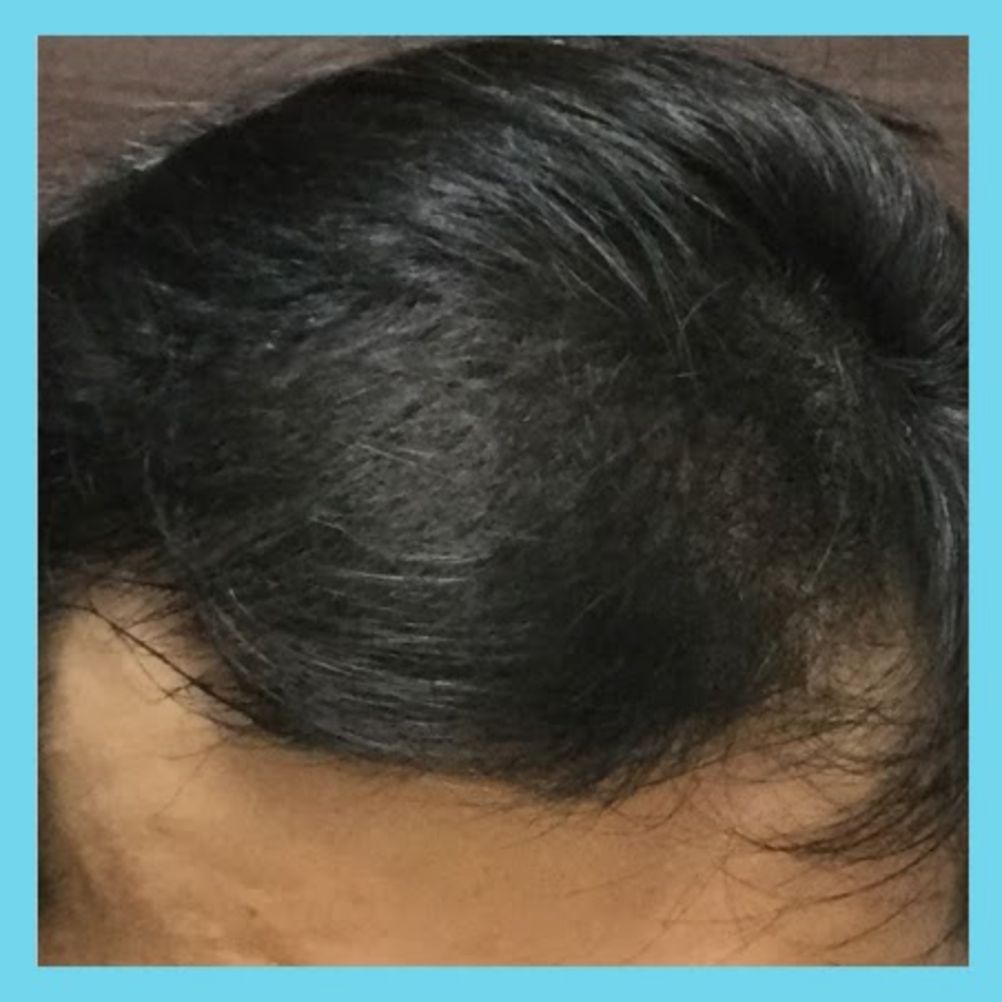 生え際の薄毛の治療後の症例写真（4ヶ月後）