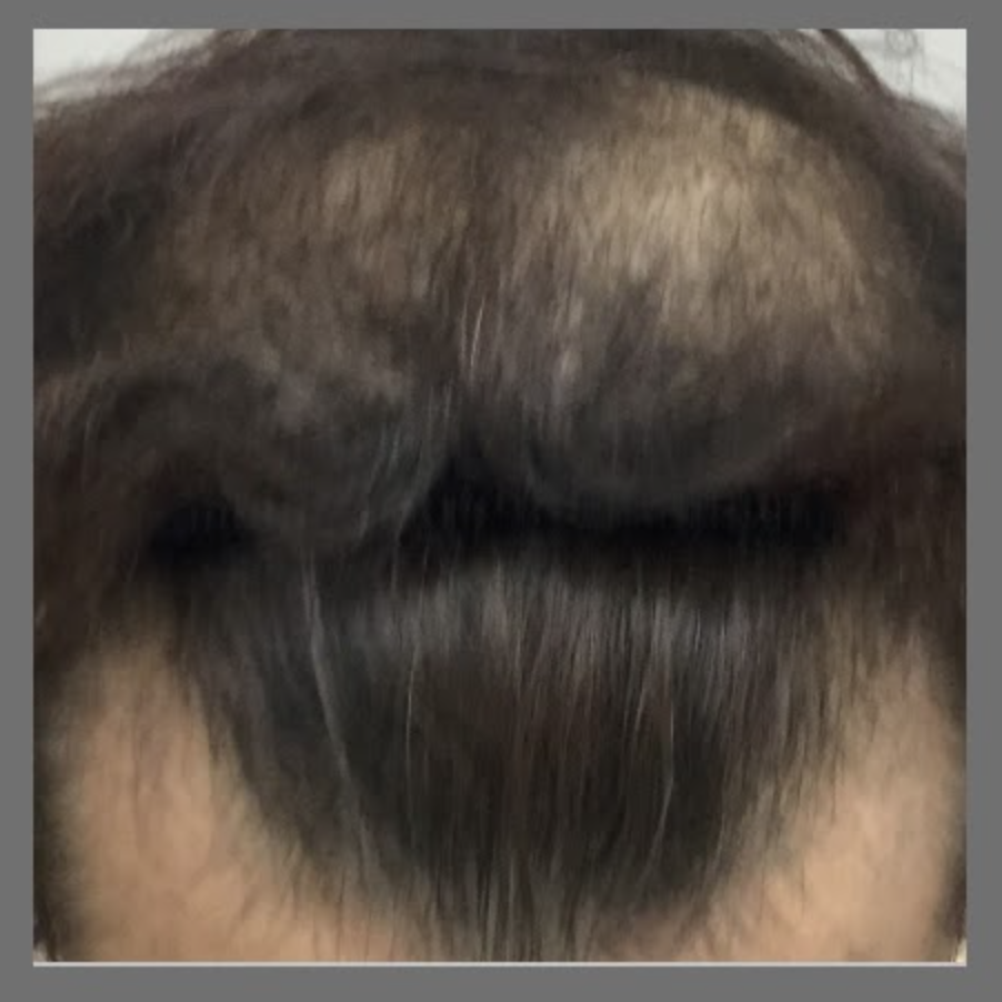AGA患者の頭部（生え際・頭頂部の薄毛）