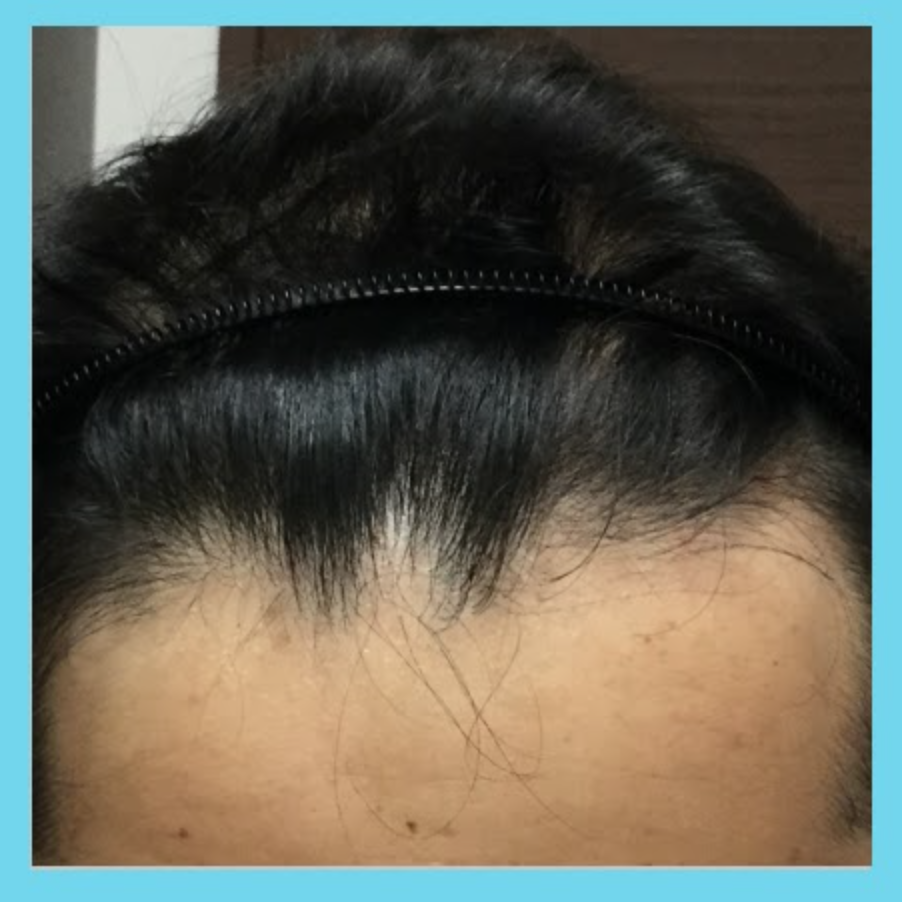 生え際の薄毛の治療後の症例写真（8ヶ月後）