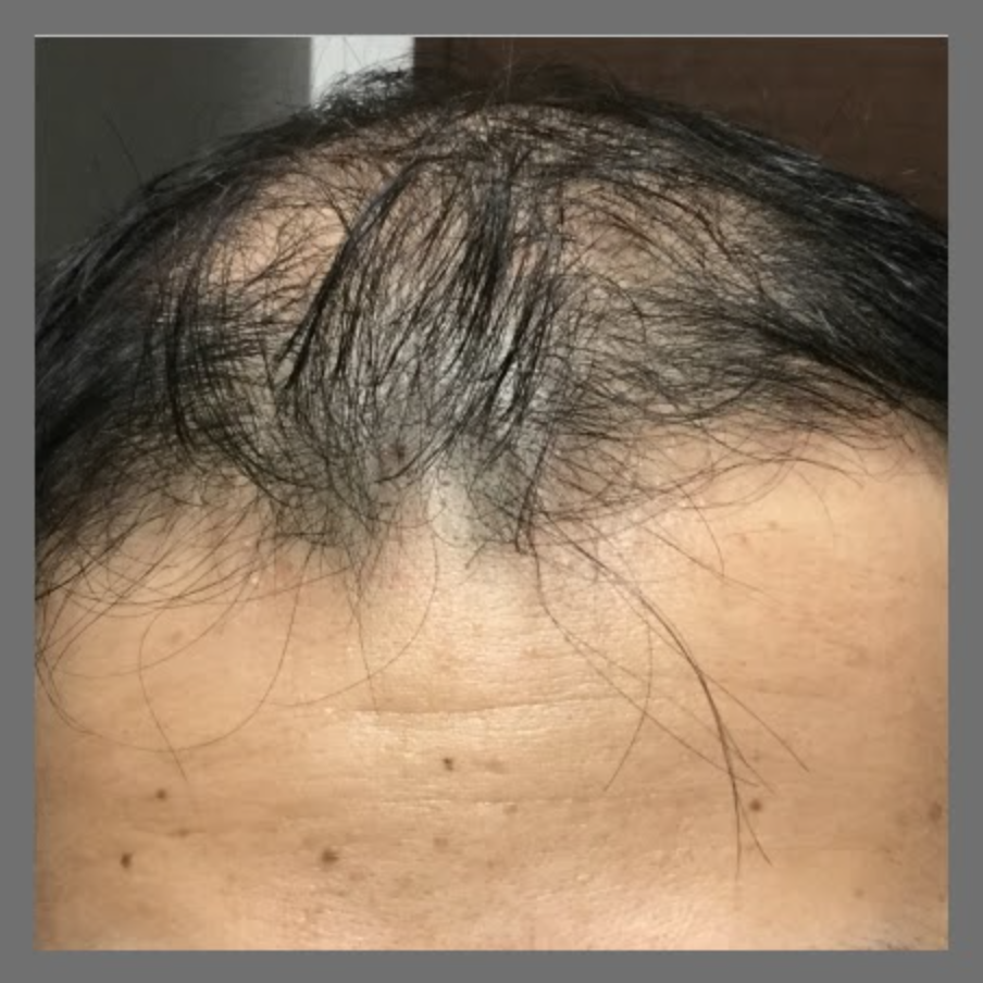 生え際の薄毛の治療前の症例写真