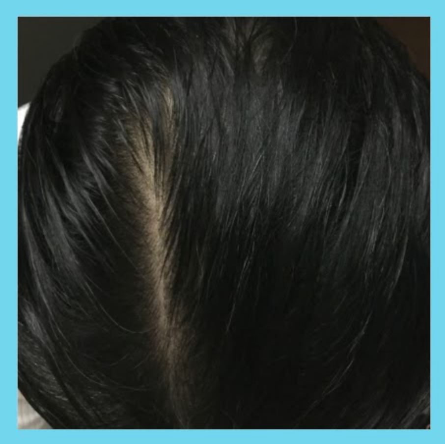 頭頂部の薄毛の治療後の症例写真（12ヶ月後）