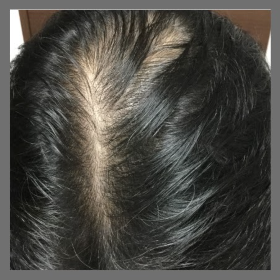 頭頂部の薄毛の治療前の症例写真