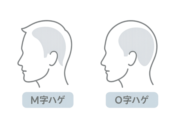 AGAの典型パターンM字ハゲとO字ハゲの比較イラスト