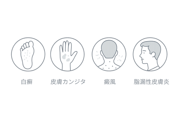 ケトコナゾールが有効な4種の皮膚真菌症を図解