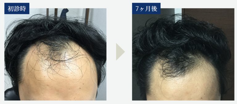 症例写真
生え際治療七か月後のビフォーアフター