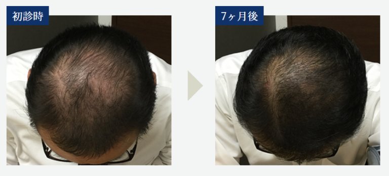 症例写真
頭頂部
治療開始7ヵ月後のビフォーアフター