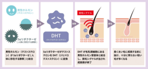 【ハゲやすい人の特徴】薄毛の前兆7つとハゲやすい人の特徴・行うべき対策を紹介 | AGA・抜け毛・薄毛治療のAGAメディカルケアクリニック【公式】