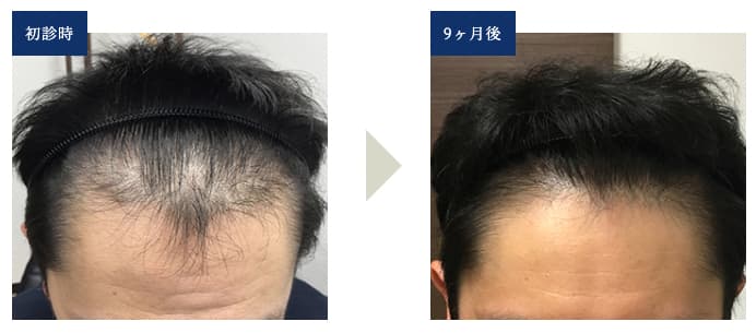 【43歳Yさん（生え際＆頭頂部の混合型）】初診と9ヶ月後の比較画像