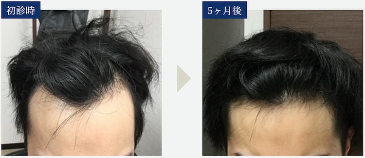【初診時と5ヶ月後の比較画像】治療法：オリジナル発毛治療+メディカルケア発毛メソセラピー